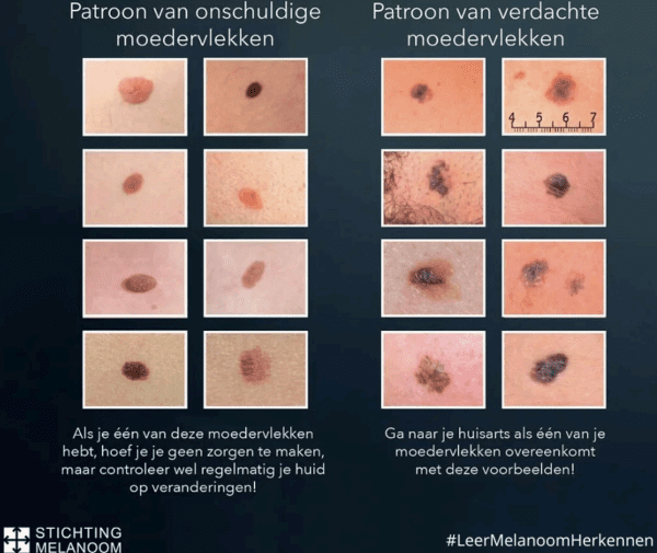 ABCDEF method for identifying skin cancer